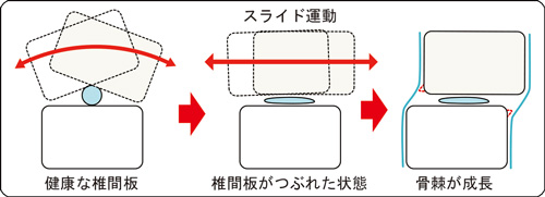 健康な椎間板・骨棘が成長した椎間板