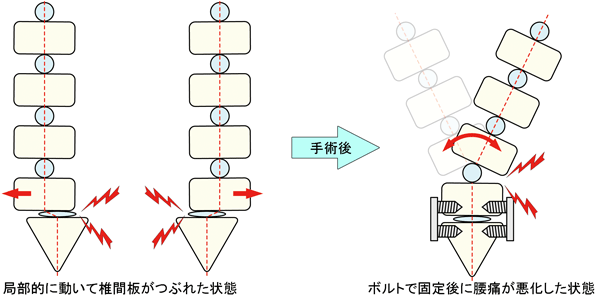 手術後の腰痛