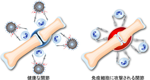 免疫細胞に攻撃される関節