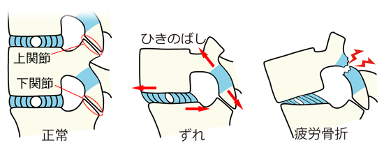 背骨の疲労骨折