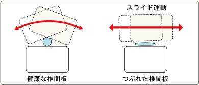 健康な椎間板 つぶれた椎間板