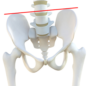 骨盤のゆがみ