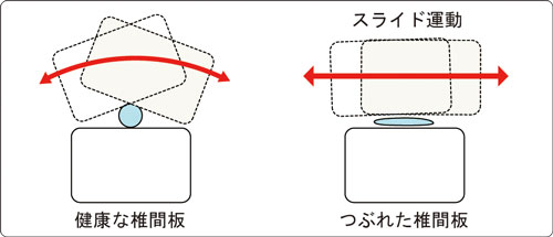 慢性腰痛の経過