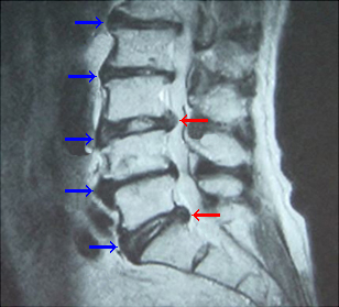 椎間板や背骨の変形
