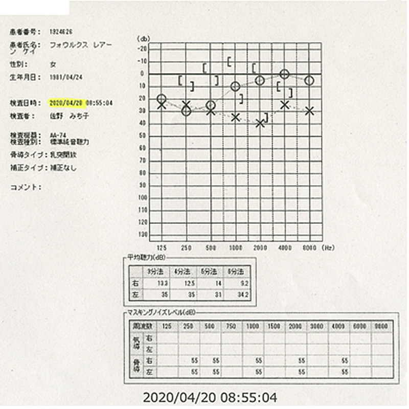 突発性難聴｜ステロイド治療後のオージオグラム