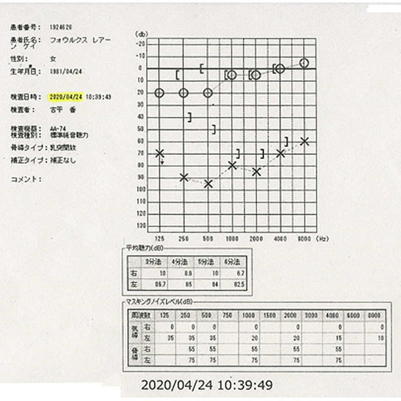 ステロイド依存性難聴｜突発性難聴でステロイドの治療をやめてから悪化したオージオグラム