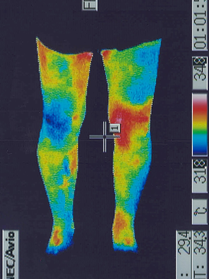 カラダの炎症を調べるサーモグラフィー検査