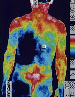 カラダの炎症を調べるサーモグラフィー検査