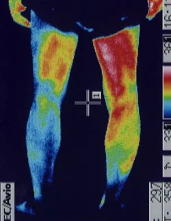 椎間板ヘルニアの坐骨神経痛｜麻痺した足の温度分布（治療前）