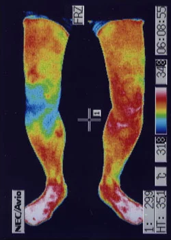 変形性膝関節症｜治療前、炎症が確認できる膝のサーモグラフィの様子