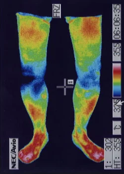 変形性膝関節症｜治療後、炎症が鎮まった膝のサーモグラフィの様子