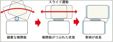 健康な椎間板・骨棘が成長した椎間板