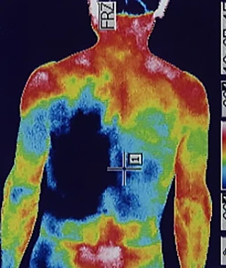 大腿骨頭すべり症｜自律神経の異常を調べるサーモグラフィの検査