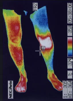 ベーカー嚢腫｜膝周辺の血流状態を確認するサーモグラフィ検査