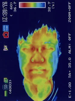 緑内障の鍼治療後の眼球の炎症｜治療後