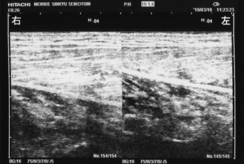 大腿骨頭すべり症｜軟部組織の損傷を調べます。