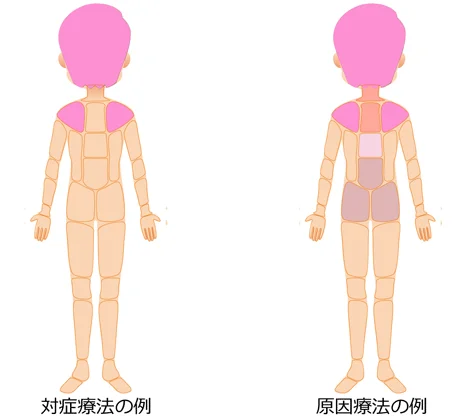 対処療法 原因療法の治療部位