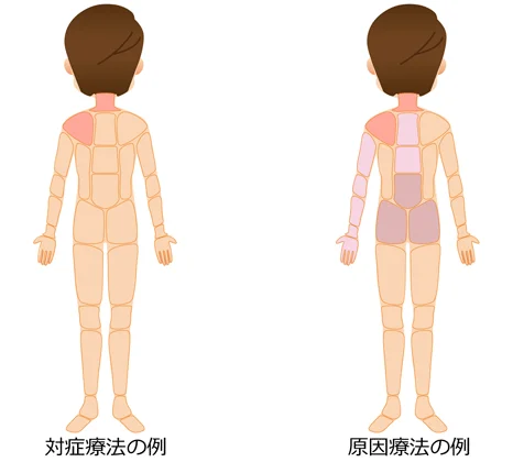 胸郭出口症候群の治療部位