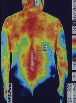 ひどい肩こり｜背中の温度分布（治療後）