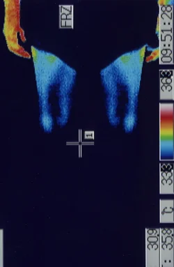 メニエール病の原因となるストレスで温度が低下したふくらはぎのサーモグラフィー