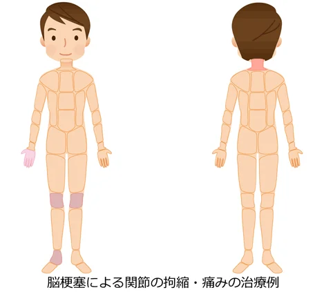 脳梗塞の関節の治療部位