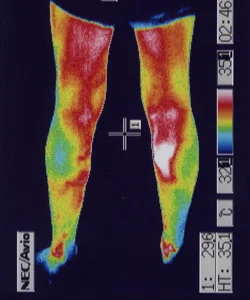 鍼治療で足の温度と血流良くなりパニック発作が起こりにくくなった足のサーモグラフィー