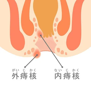 痔核硬化療法後遺症の鍼治療