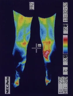 帯状疱疹の検査｜第二の心臓と言われるふくらはぎの温度を調べます。