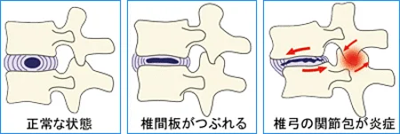 ぎっくり腰