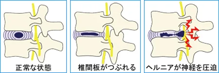 椎間板ヘルニア