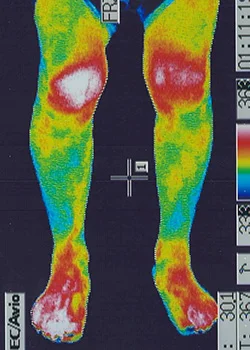 鍼治療前の膝と足首の炎症