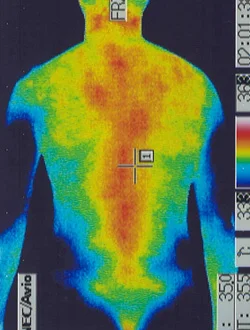 鍼治療で良くなった慢性疲労性症候群