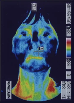 鍼治療前の顔の温度