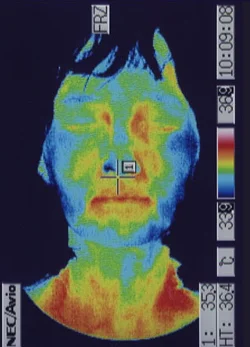 鍼治療後の顔の温度