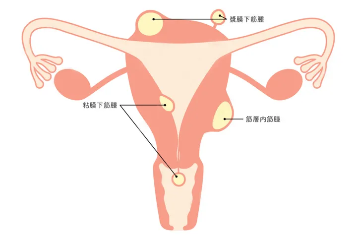 子宮筋腫：筋層内筋腫、粘膜下筋腫、漿膜下筋腫